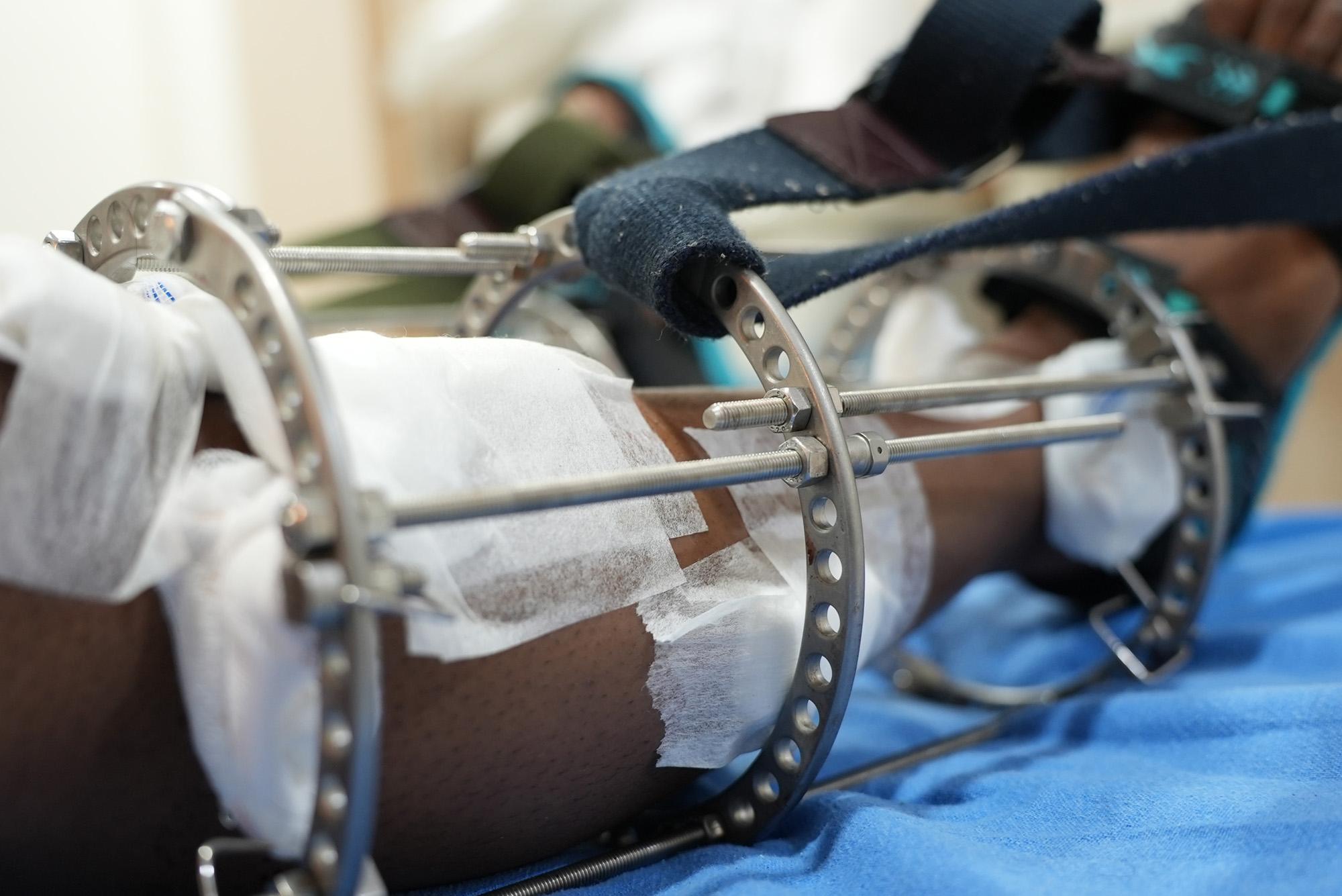 Close-up of Ilizarov external fixator used in limb lengthening surgery
