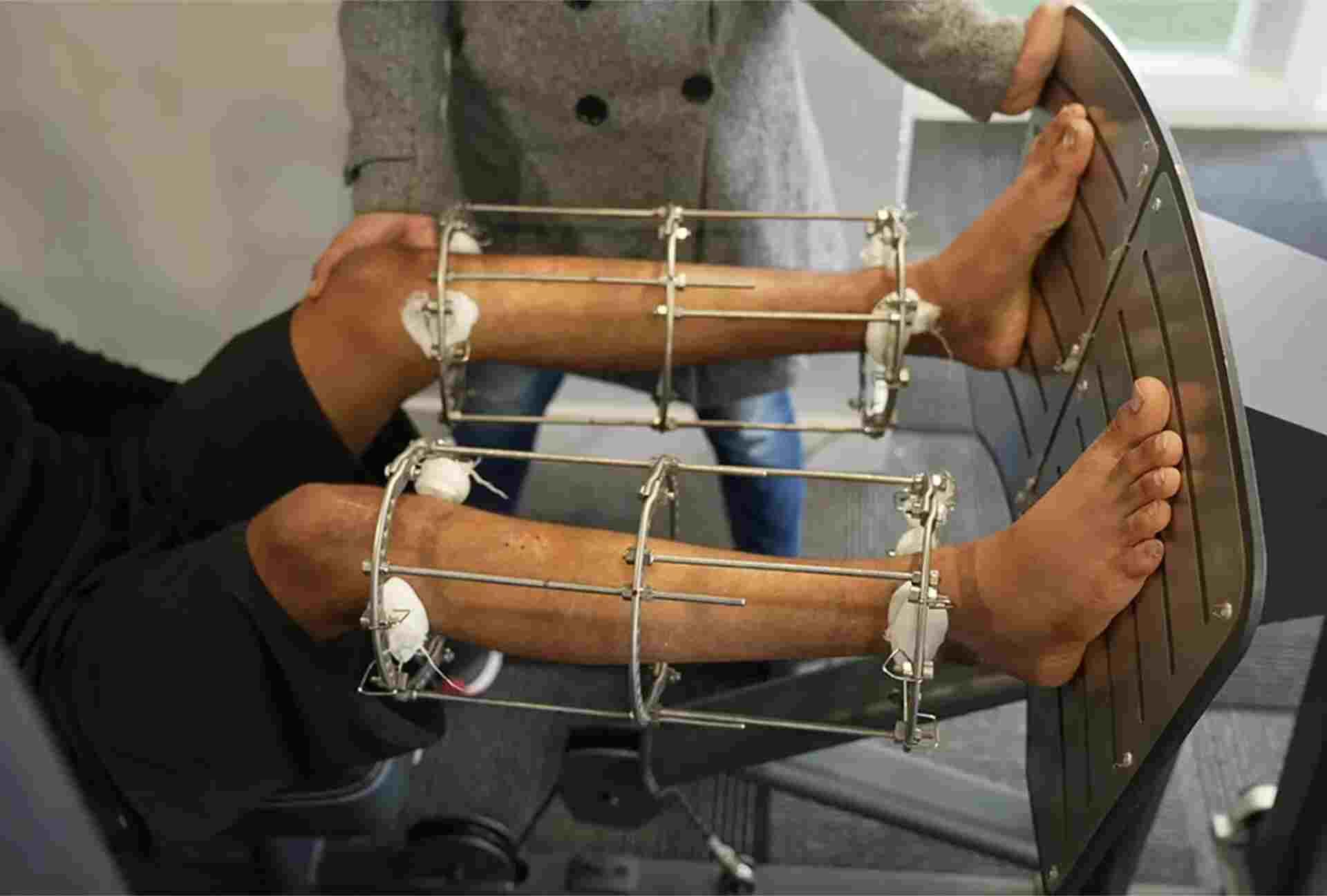 Limb lengthening surgery recovery process at Heights Plus India