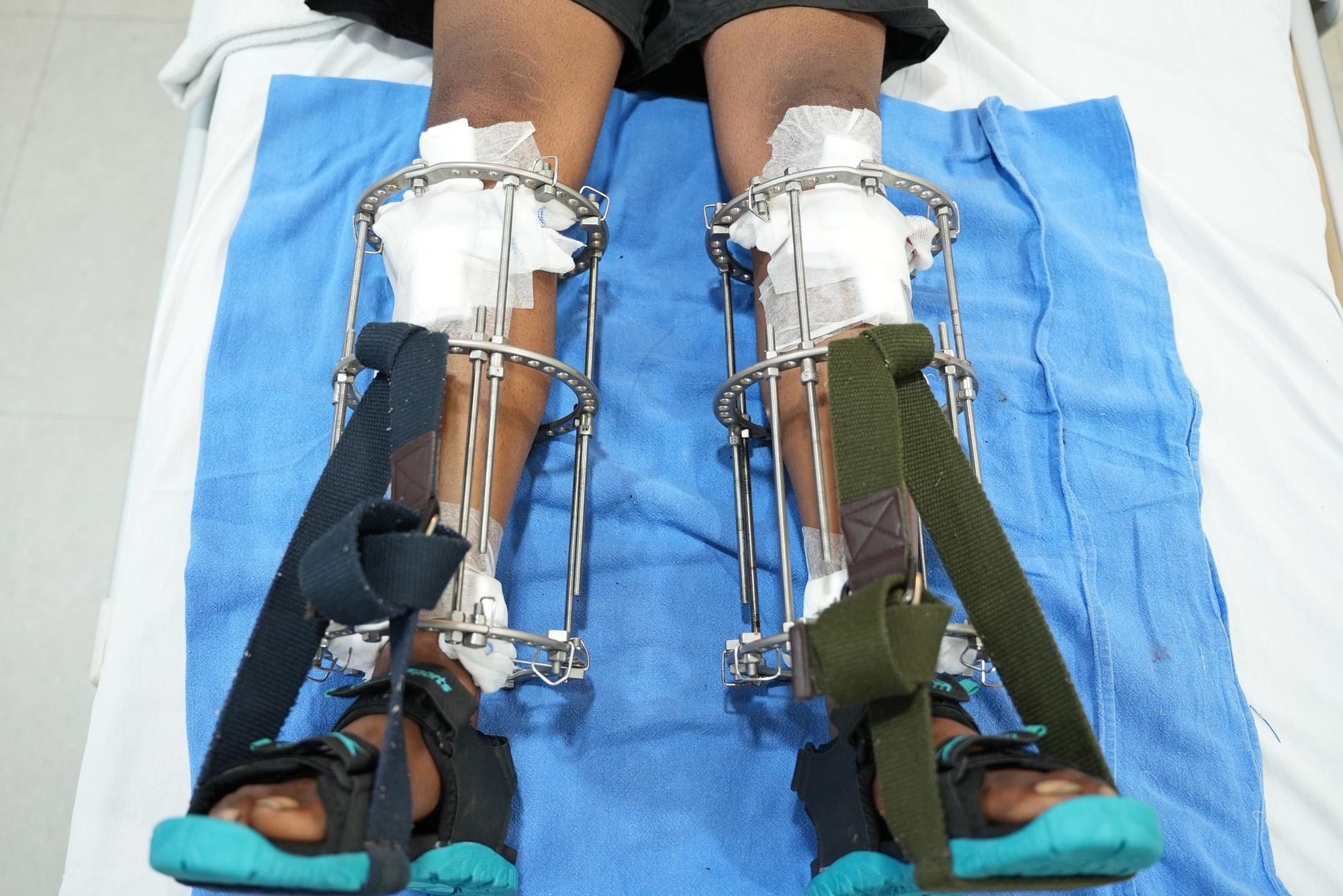 Bilateral deformity correction using circular external fixators on both legs