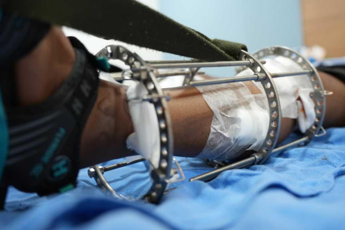 Detailed view of orthopedic hardware for bone stabilization and lengthening